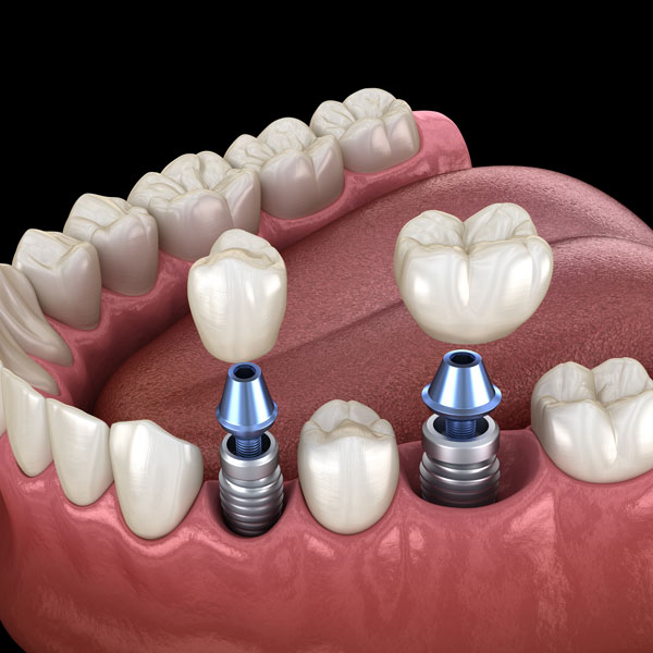 3D model of dental implants